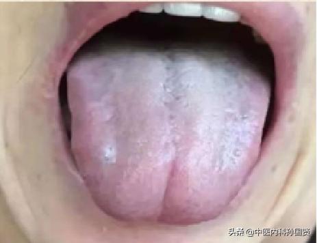 春季养肝正当时，逍遥丸、越鞠丸、柴胡舒肝丸，如何通过舌象选？