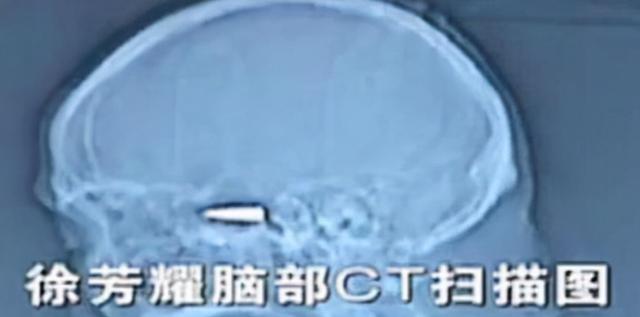 2010年，湖南独眼老农头疼求医，发现颅中子弹，暴露老兵身份