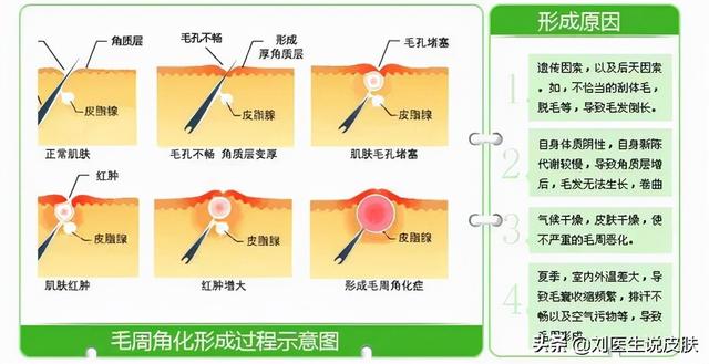 皮肤起鸡皮眼