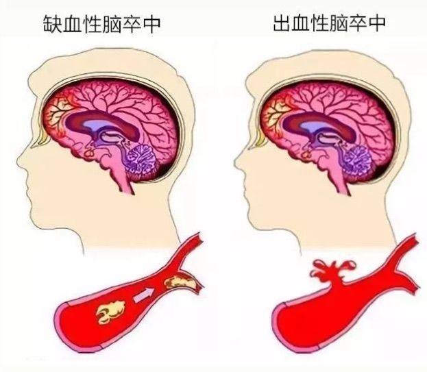 脑梗和脑血栓，有什么不一样？医生：一个是果，一个是因