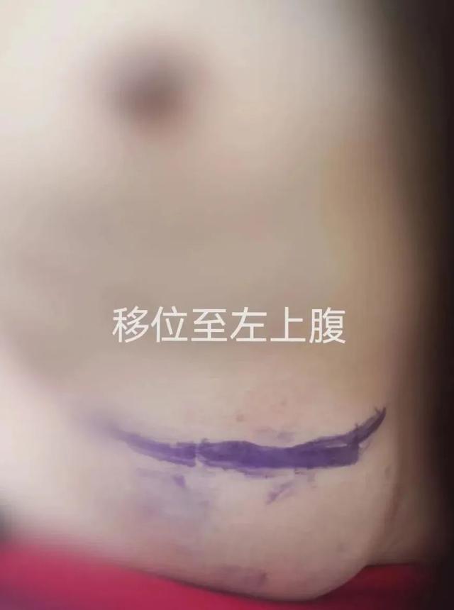 “胸”跑到了背上，只因注射了奧美定
