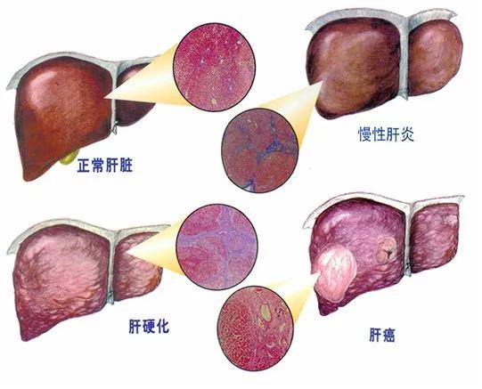 刘渡舟加味柴胡汤治疗慢性肝炎晚期