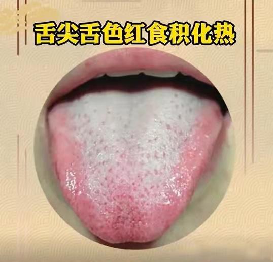 舌象分析，看看正常的和异常的舌象对比