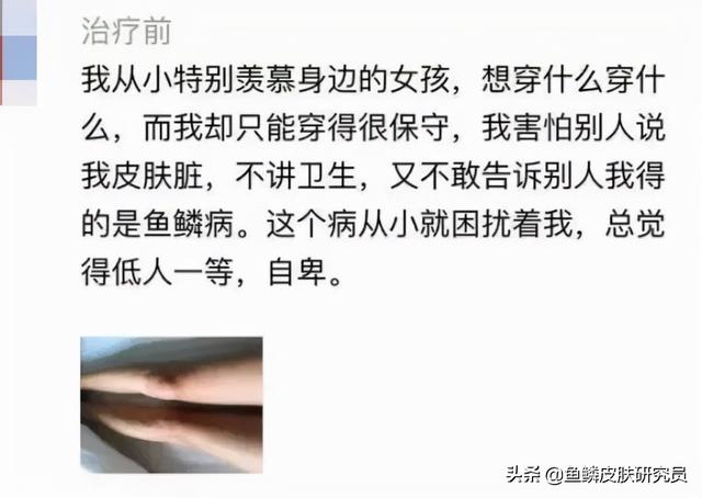 鱼鳞病有人治好的吗