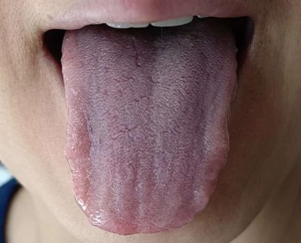 逍遥丸、柴胡舒肝丸、越鞠丸如何通过舌像选？春季养肝秘诀在这里