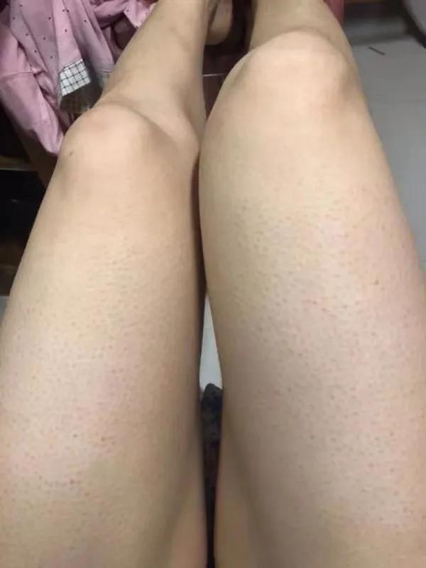 鸡皮肤怎么遮挡
