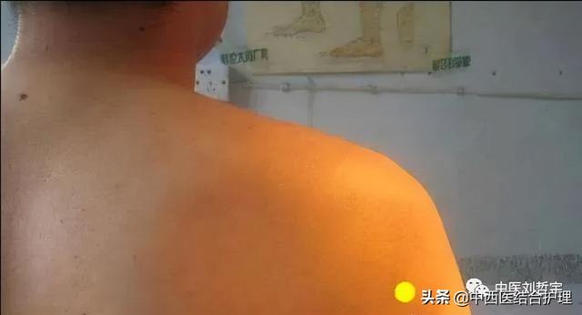 「穴位养生」上肢部常用平衡穴位（共11穴），超使用哦