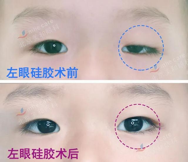 五年八部曲，上睑下垂分阶段治疗的故事