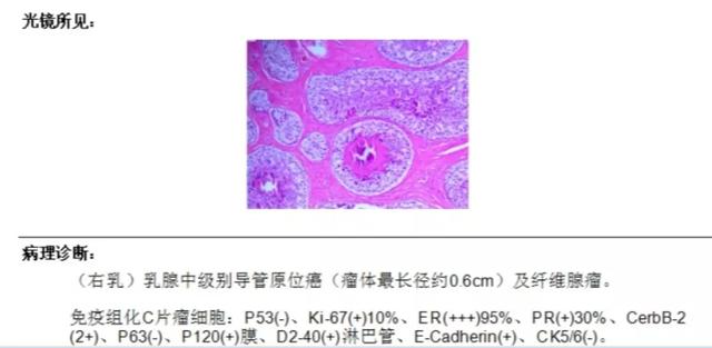 聯合檢查，讓乳腺導管原位癌無處可逃