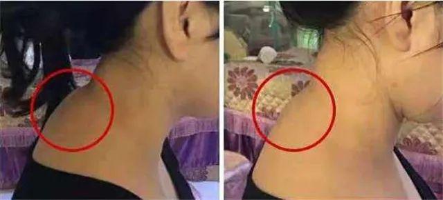 横纹是脑梗纹、竖纹是脑出血纹、凸起是炸药包，一定要及时疏通