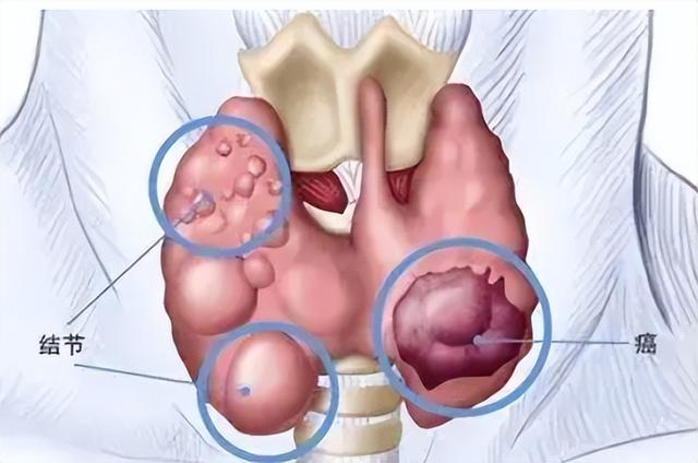 甲状腺结节癌变容易找上这几类人，早期4个症状要留心