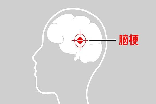 夏季是脑卒中“高峰期”，这三点原因不容忽视，警惕头部症状-太公奇门网