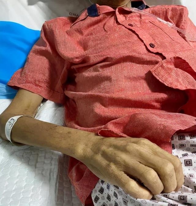 癌症患者极度消瘦？不是癌细胞抢夺营养那么简单！如何有效应对？