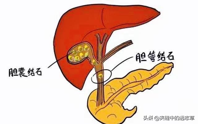 肝胆结石？讲九味中药，兵分三路，一路排石，一路疏肝，一路止痛
