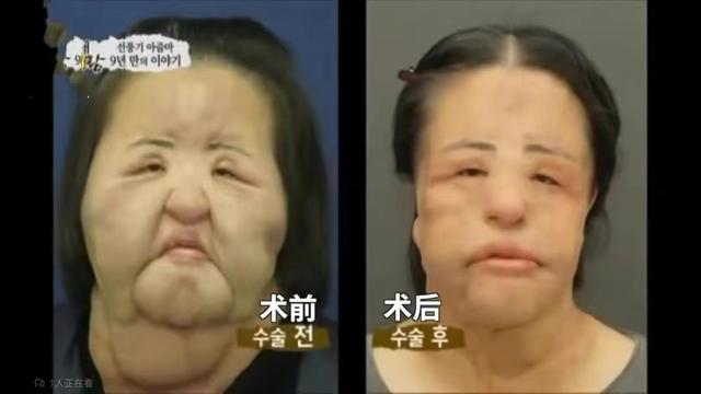韩慧景：把自己整成“电风扇”，注射食用油代价惨痛，我悔不当初