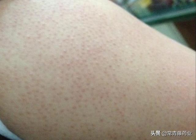 鸡皮肤比较厉害跟内分泌有关系么