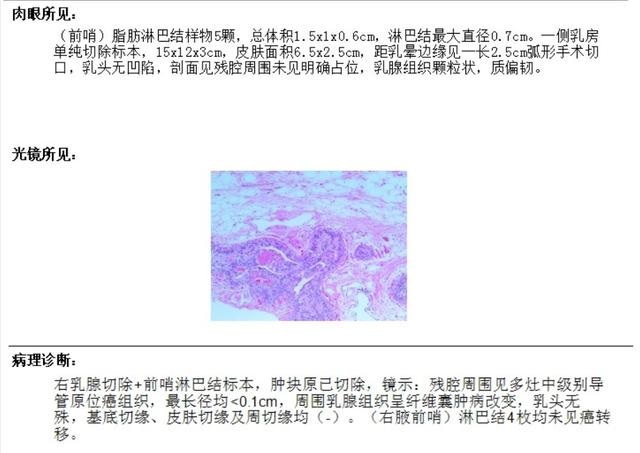聯合檢查，讓乳腺導管原位癌無處可逃
