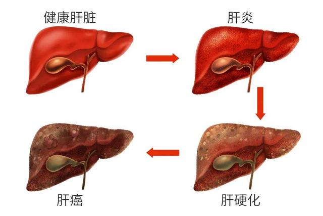 乙肝患者除了不能喝酒，这4种食物也要少碰，早知道早受益
