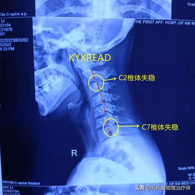 肩胛骨疼痛、手麻、整天头昏脑胀，是更年期综合症吗？不要被糊弄