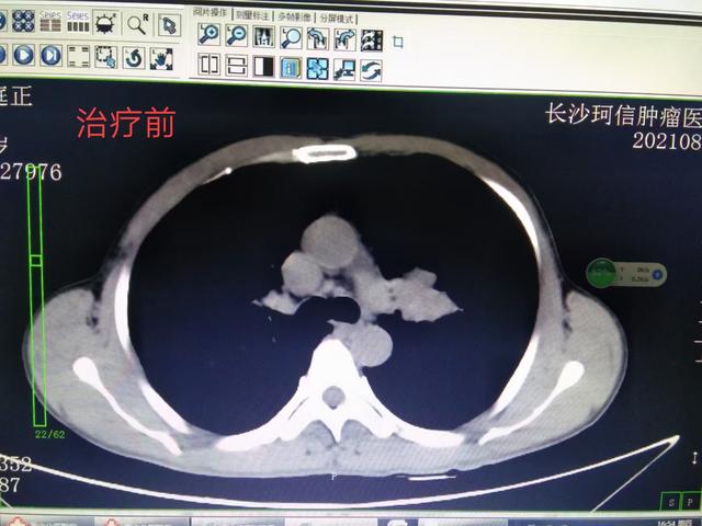 肺部鱼鳞癌的化疗要几个疗程