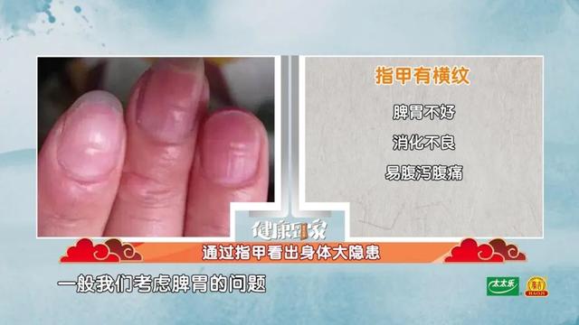 手指甲满足3个特点，多半是身体在“求救”！赶紧自测