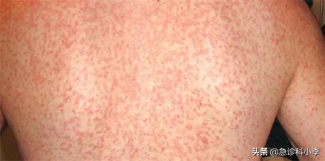 胳膊上好多小红点