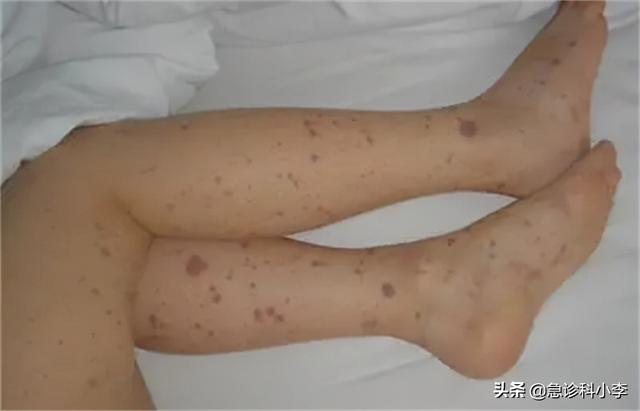 胳膊上好多小红点