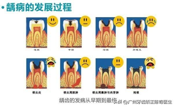 為什麼現在10個小孩里7個有蛀牙！別等小孩滿嘴爛牙再後悔 - 天天要聞