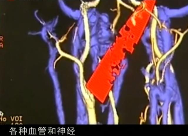 11年云南男子头疼呕吐，身上散发臭味，检查发现脑中插着一把匕首