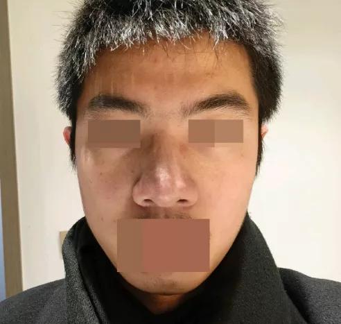 鼻头肥大怎么办