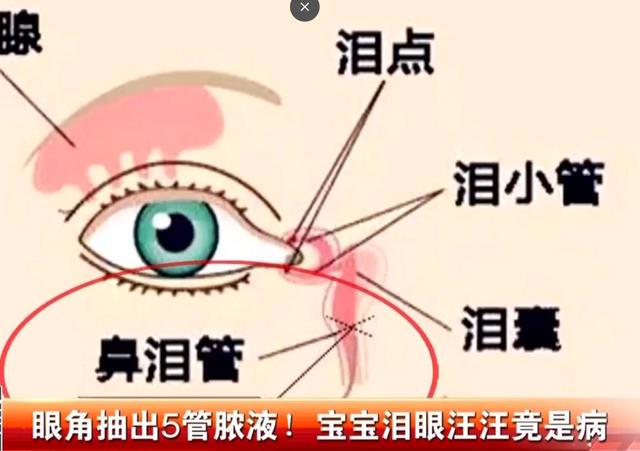 4个月大婴儿眼角抽出5管脓液！20个宝宝1个中招，拖延治疗有风险