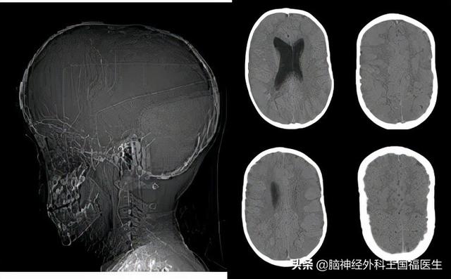 孩子忽然呆住持续1分钟，上课突然起身，是癫痫？!还有隐藏病因..