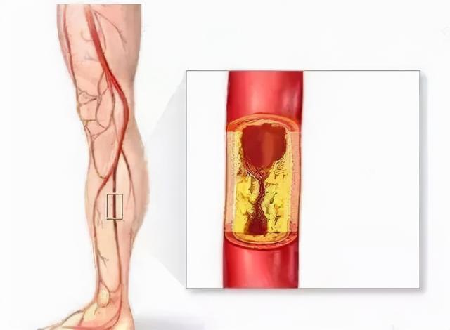 走路腿疼，走走又停停，警惕是这种病
