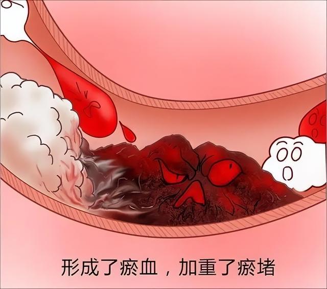 长期耳鸣？多半是气虚血瘀！1个方子，帮你益气活血，通利耳窍