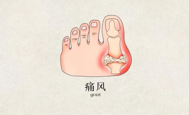 关节部位有肉眼可见的结节？可能是痛风石的表现，3大危害要熟知