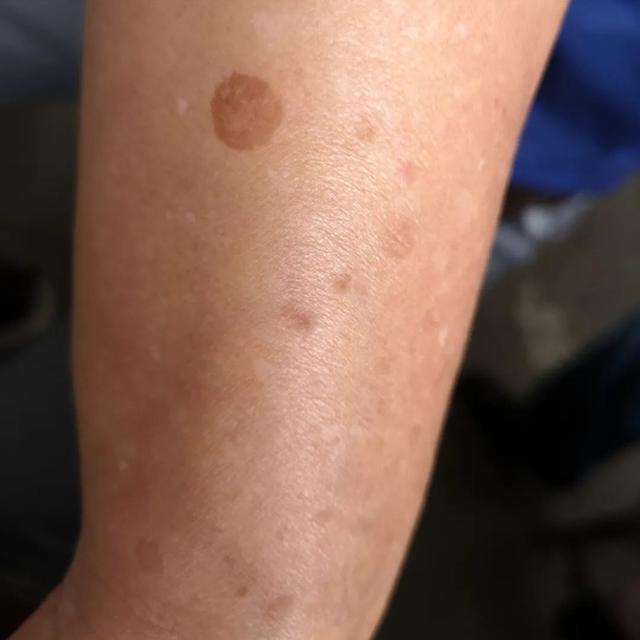 手心透明疙瘩点状角化病