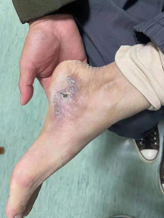 鸡皮肤黑色突起