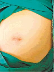 26岁孕妈发现盆腔巨大肿瘤 经单孔腔镜手术切瘤保胎成功