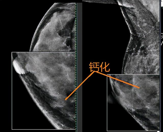 聯合檢查，讓乳腺導管原位癌無處可逃