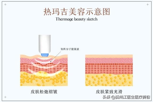 特别严重的法令纹还有得救么？ - 全网搜