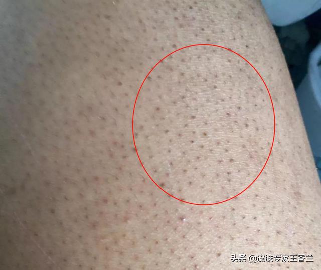 如何治鸡皮肤是什么样