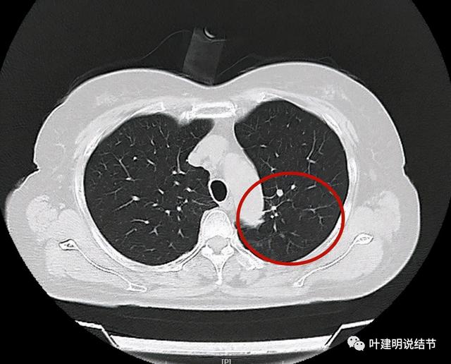 左肺占位进一步检查什么意思