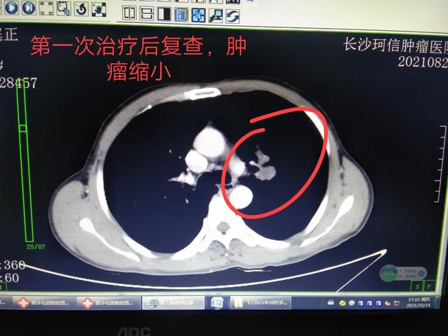 肺部鱼鳞癌的化疗要几个疗程