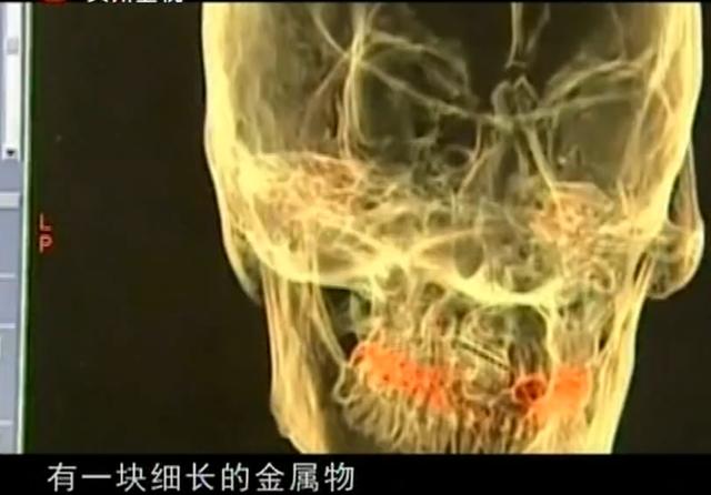 11年云南男子头疼呕吐，身上散发臭味，检查发现脑中插着一把匕首
