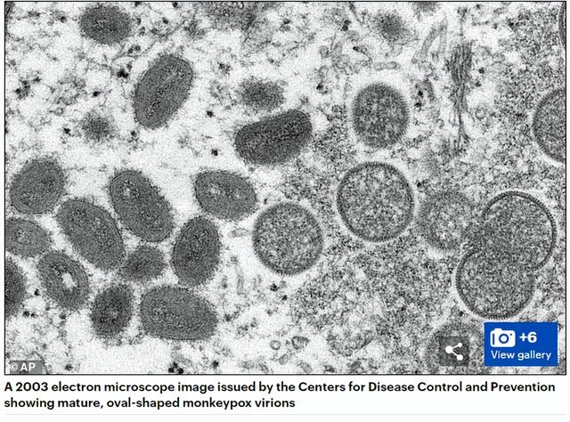 首个国家发隔离禁令! 澳洲确诊2例猴痘, 15国沦陷, 无防护治愈手段
