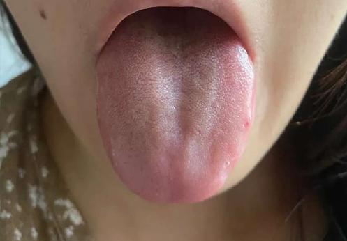 春季养肝，逍遥丸、丹栀逍遥丸、加味逍遥丸如何选？舌象告诉你