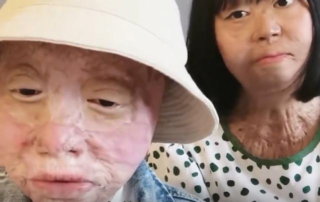 乔燕：因汽车自燃被烧伤，全脸毁容双手截肢，928天后涅槃重生
