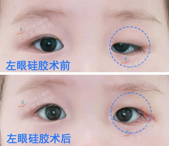 五年八部曲，上睑下垂分阶段治疗的故事