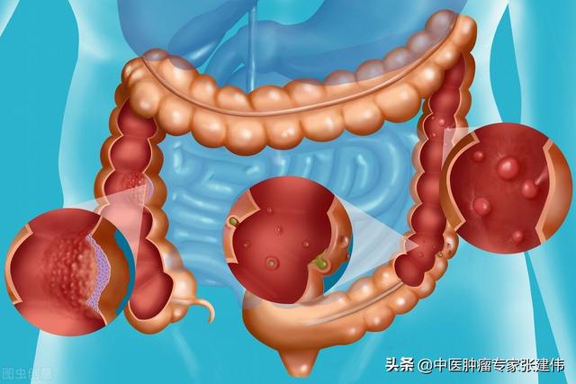 為什么第一次腸鏡檢查要放40歲?醫生：3個無癥狀的案例告訴你答案