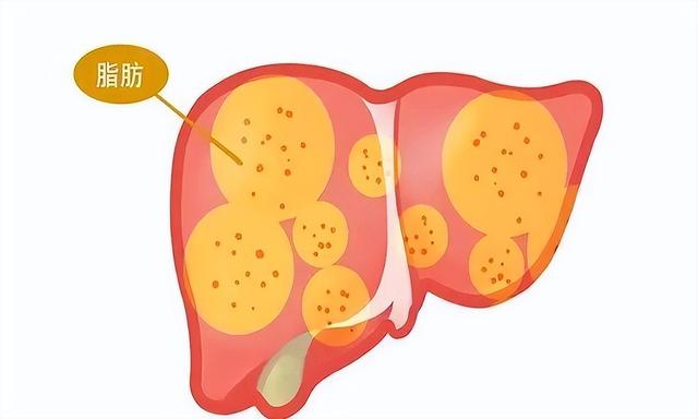 患有脂肪肝的人这4种食物要忌口，以免加重病情，需重视